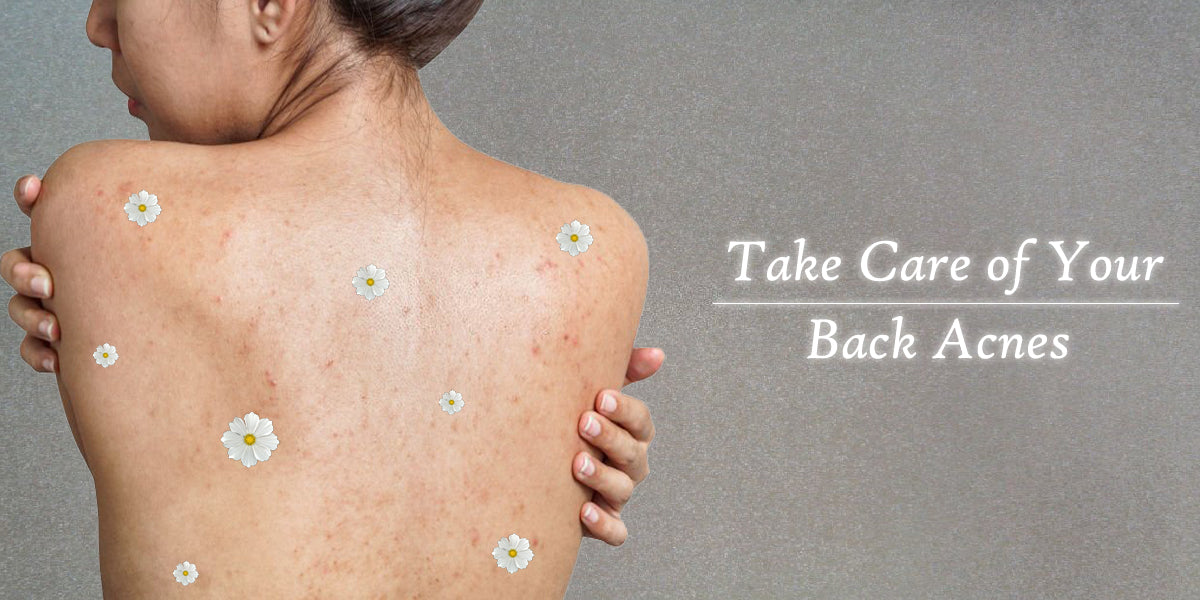 Ways to heal Back Acnes Faster