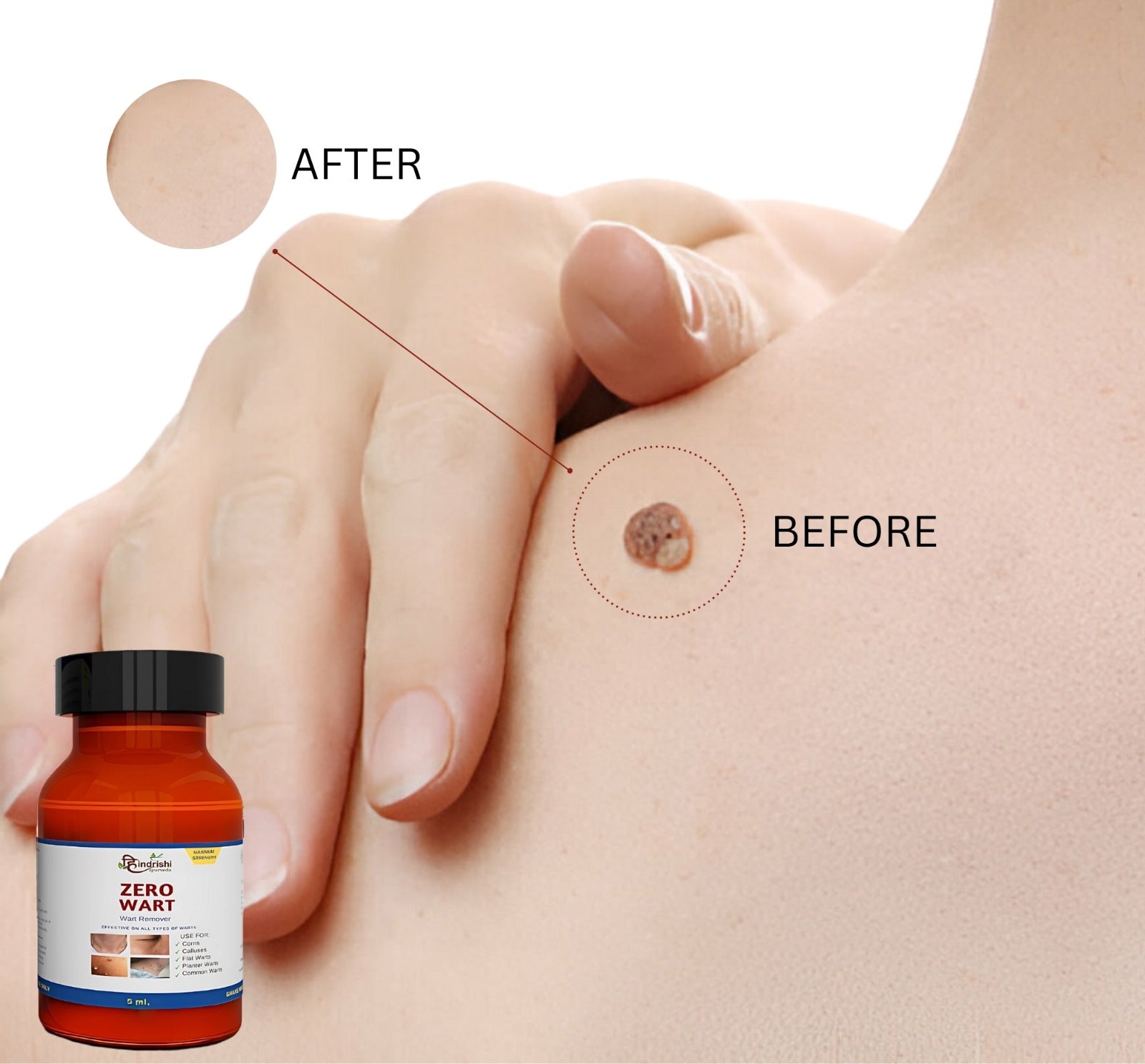 Zero Wart 5ml - Effective Wart Remover Solution (PACK OF 2)